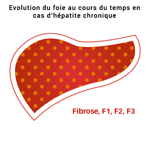 A, B, C, D, E, une hépatite c'est quoi ? | Aides